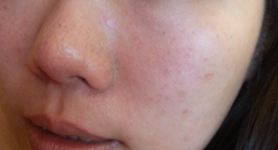 什么是脸部屏障受损,什么是屏障受损痘肌