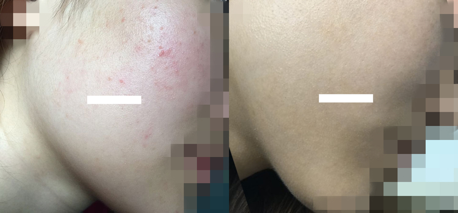 什么是脸部屏障受损,什么是屏障受损痘肌