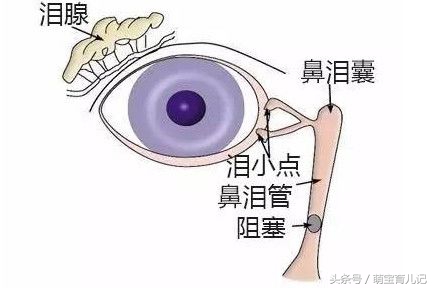 新生儿眼屎多是泪道阻塞吗,宝宝眼睛眼屎多怎么解决