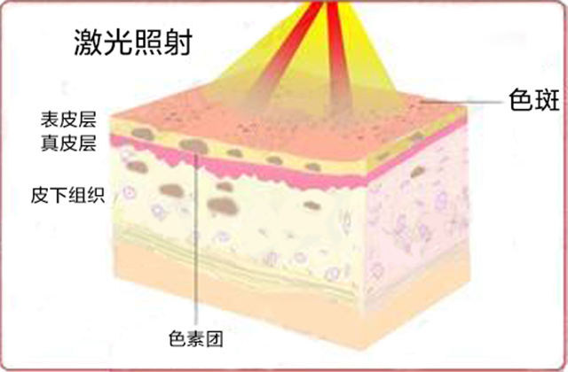 光子嫩肤祛斑后怎么看效果,光子嫩肤去黑点