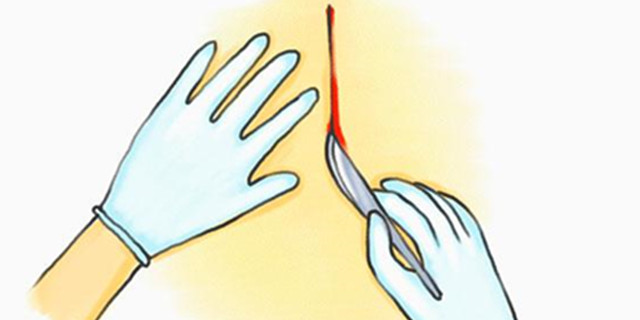 什么是侧切和撕裂,什么是侧切生孩子