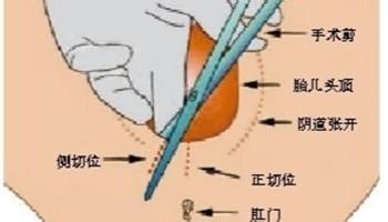 什么是侧切和撕裂,什么是侧切生孩子