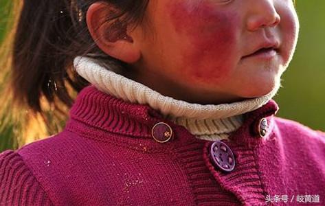 脸蛋红是心脏病的征兆,心脏导致脸发红的症状