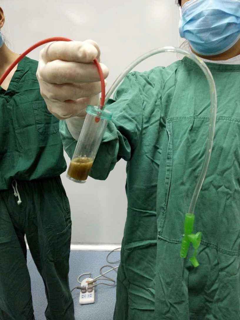 27岁产妇分娩“羊水栓塞”ICU住3天花10万仍然无力回天