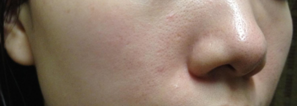 什么是脸部屏障受损,什么是屏障受损痘肌