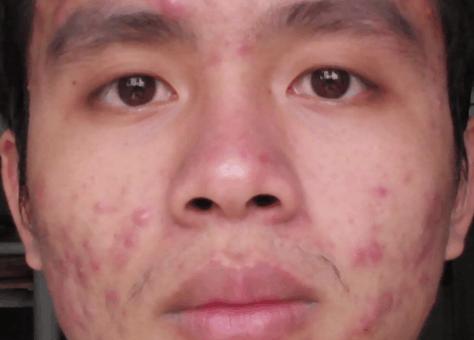 为什么痘痘久治不愈?你可能是激素依赖性*疮痤**