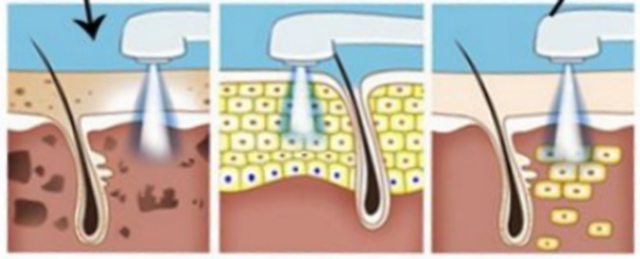 光子嫩肤祛斑后怎么看效果,光子嫩肤去黑点