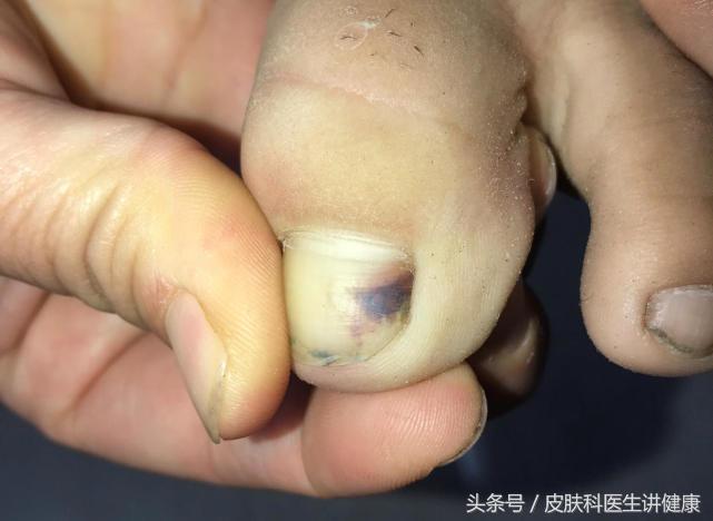 甲下黑色素瘤会不会指甲一夜变黑,指甲发黑是大脑血管有杂质吗