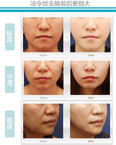 怎么去除法令纹最有效的方法医美,去皱纹最好的方法去法令纹