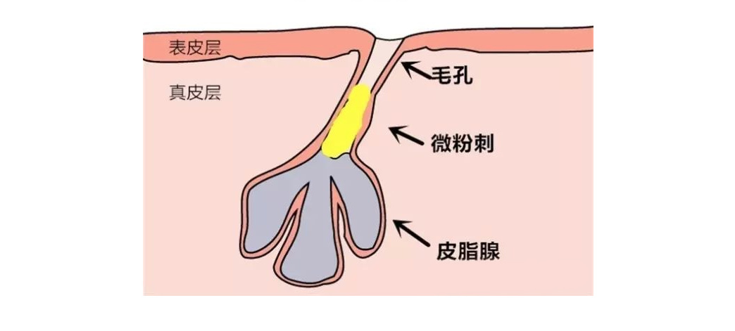 什么是脸部屏障受损,什么是屏障受损痘肌