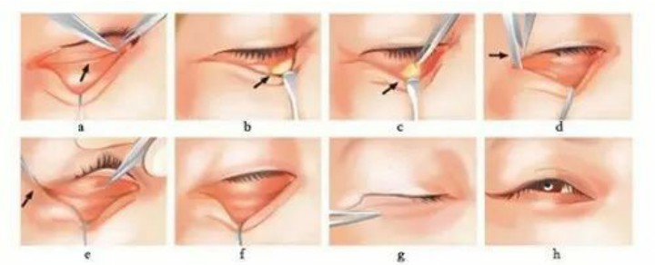 学会这几个动作改善眼部问题,学会这三招女人眼袋再重也能治好