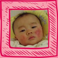 湿疹的相关介绍,湿疹的病因及临床表现转载