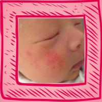 湿疹的相关介绍,湿疹的病因及临床表现转载