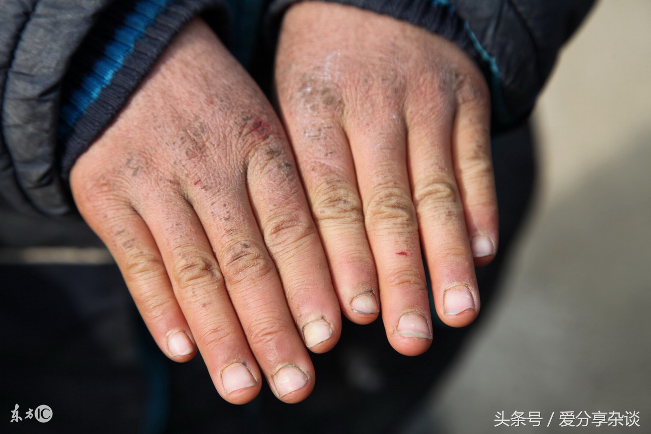 脚上长冻疮了怎么快速处理恢复,脚上冻疮怎么办最有效的方法