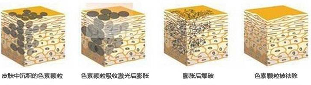 光子嫩肤祛斑后怎么看效果,光子嫩肤去黑点