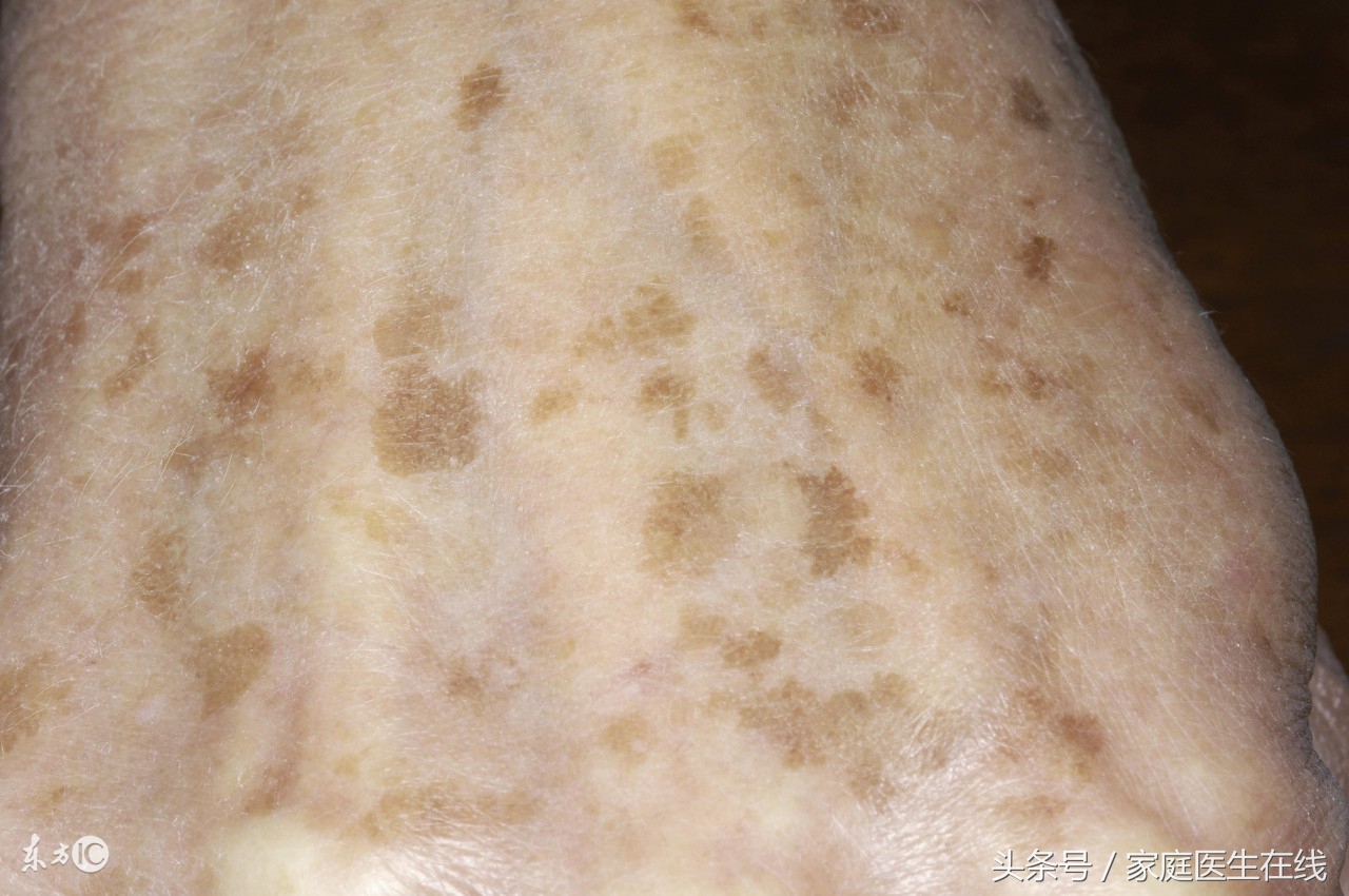 手上长老年斑影响美观,脸上容易长老年斑怎么办