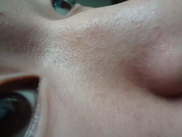 脸上有小疙瘩小颗粒解决办法,脸上小疙瘩怎么处理