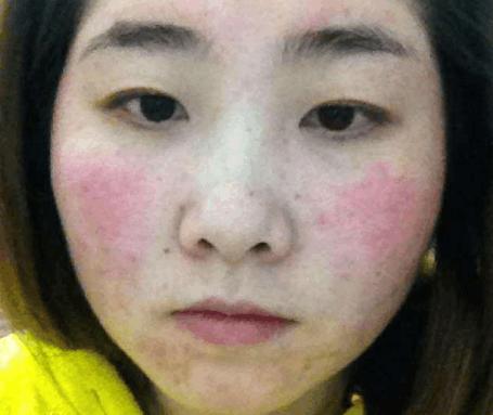 激素依赖性皮炎最快的修复方法,激素脸依赖性皮炎怎么修复