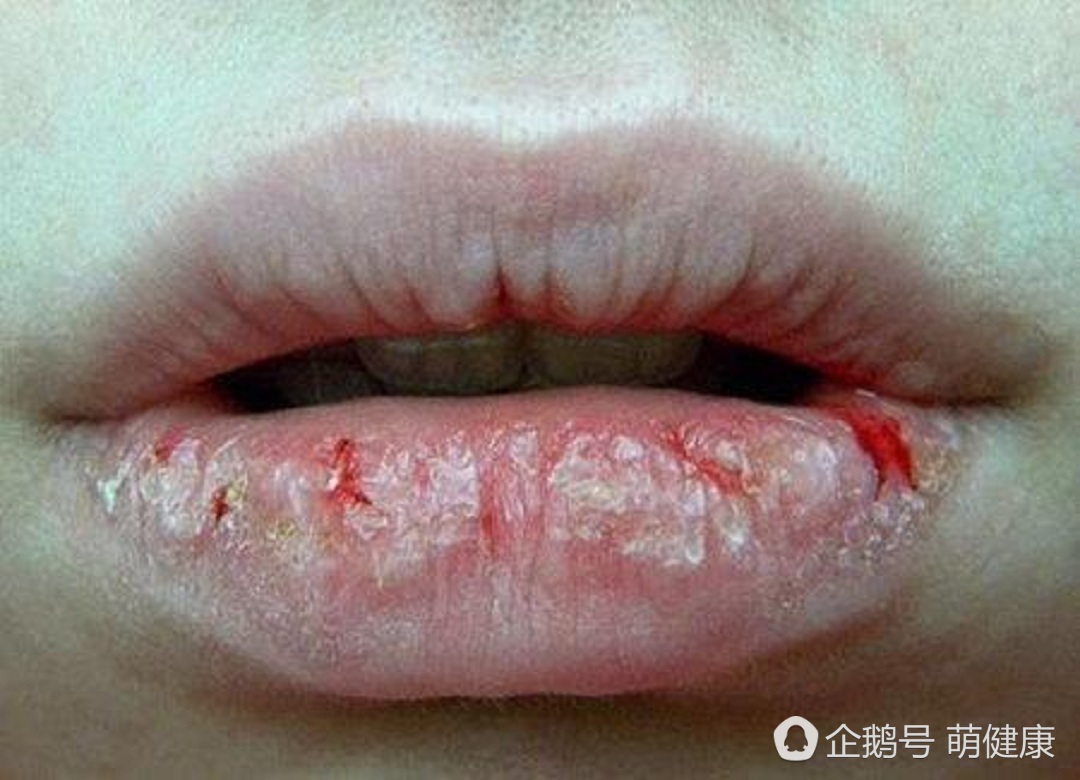 解决嘴唇干裂的小妙招,嘴唇干裂怎么缓解小妙招