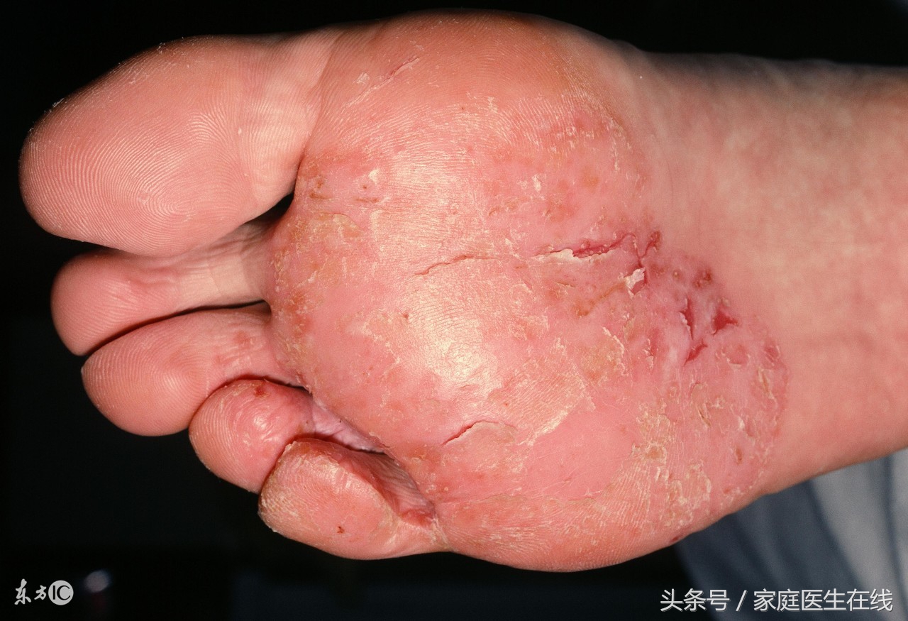 脚趾疼警惕大病,脚肿胀要当心这7种疾病