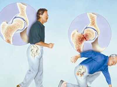 关于骨质疏松这些事你得知道,关于骨质的问题