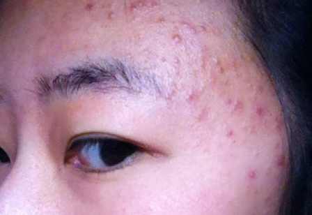 如何治疗毛囊炎的最有效方法,毛囊炎怎么患上的