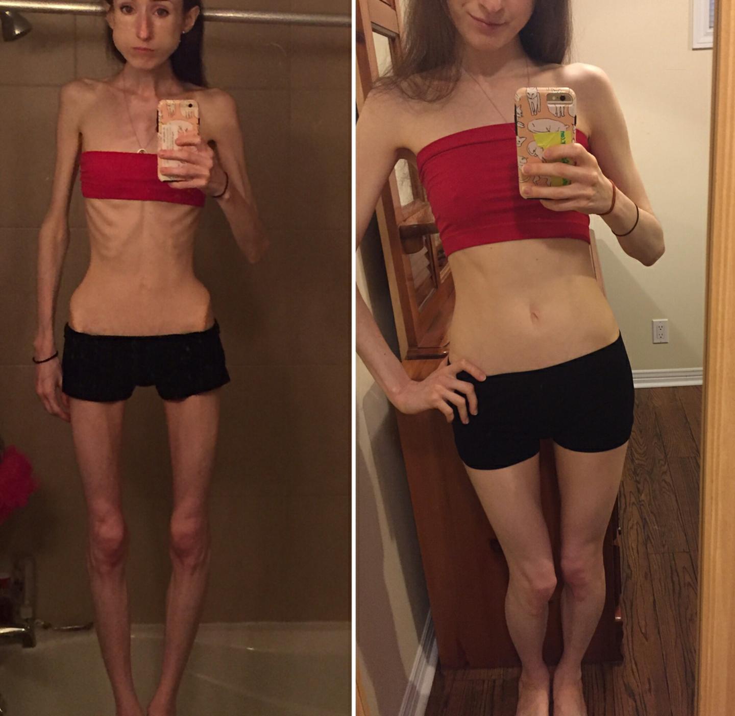 对厌食症人怎么做心理治疗,对厌食症患者怎么心理指导