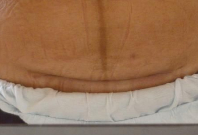 剖腹产后刀口发痒怎么回事,女人剖腹产两年疤痕痒痒