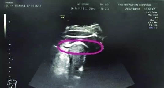 孕妈妈被宝宝踢青肚子,宝宝把妈妈肚子踢破了