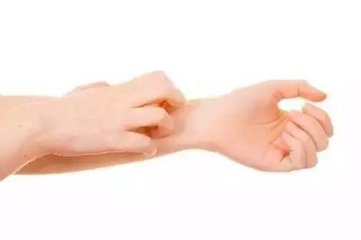 痒了十多年的皮肤病,神经性皮炎不痒增厚怎么治疗