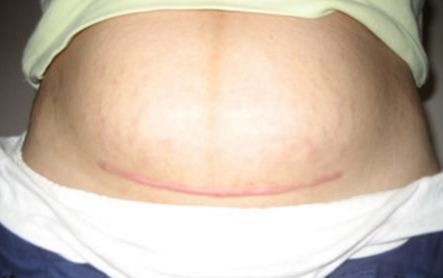 剖腹产后刀口发痒怎么回事,女人剖腹产两年疤痕痒痒