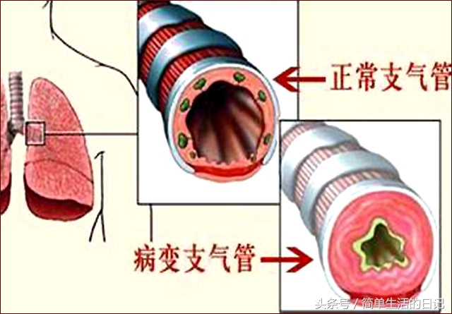 老人慢性支气管炎吃什么食物,治疗慢性支气管炎的药能随便吃吗