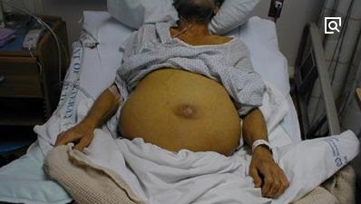 怎么才能把肝腹水弄出来,怀孕出现肝腹水是怎么回事