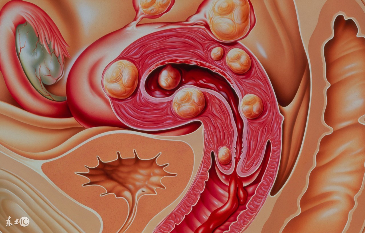 检查子宫肌瘤有哪些项目,正确检查子宫肌瘤的方法有哪些