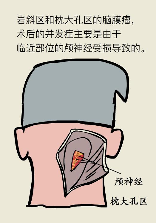 脑袋里长瘤子一定要切除吗,脑袋里长瘤能治好吗