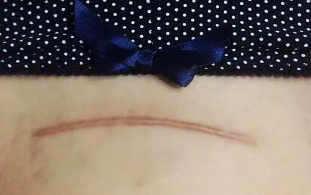 帮贝安送给你:剖腹产后9个康复小锦囊