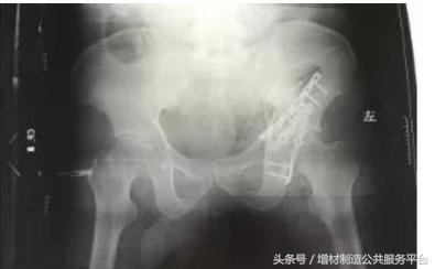 3d打印骨盆骨折成功案例,骨盆骨折抢救视频