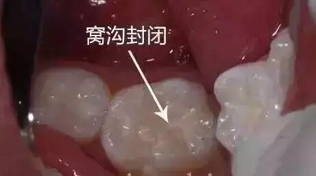 儿童牙齿黑乎乎的,孩子牙齿里面黑黑的怎么回事