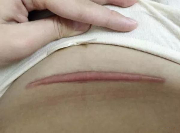 帮贝安送给你:剖腹产后9个康复小锦囊