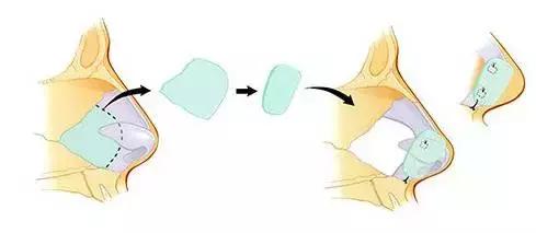 假体隆鼻都有什么术式,假体隆鼻一般用什么材料