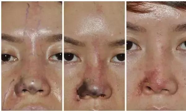 假体隆鼻都有什么术式,假体隆鼻一般用什么材料