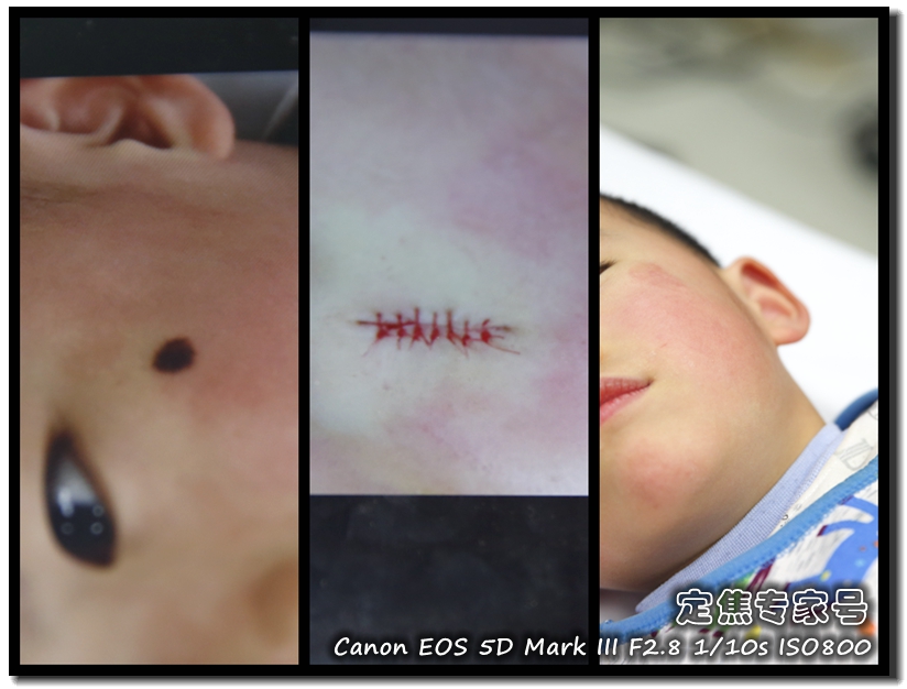 头皮癣治疗要多少钱,治疗头皮型银屑病需要多少钱