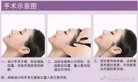 线雕的优势,线雕的效果