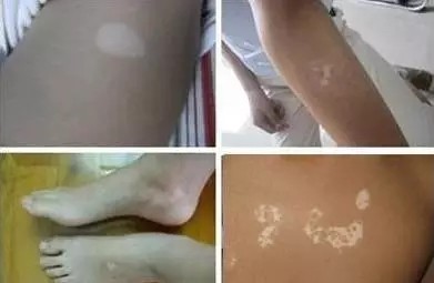 得了白癜风焦虑怎么办,焦虑诱发白癜风可以痊愈吗