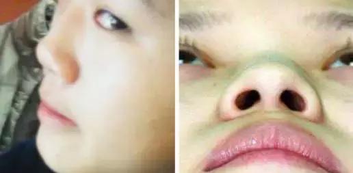 假体隆鼻都有什么术式,假体隆鼻一般用什么材料