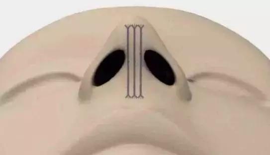 假体隆鼻都有什么术式,假体隆鼻一般用什么材料