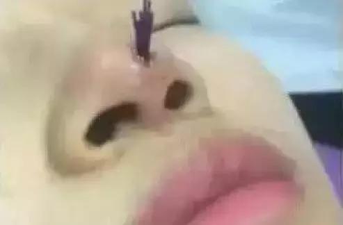 假体隆鼻都有什么术式,假体隆鼻一般用什么材料