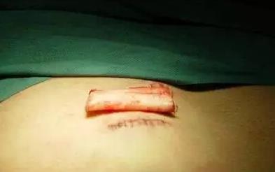 假体隆鼻都有什么术式,假体隆鼻一般用什么材料