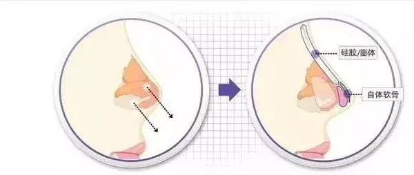 假体隆鼻都有什么术式,假体隆鼻一般用什么材料