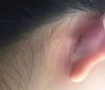 假体隆鼻都有什么术式,假体隆鼻一般用什么材料